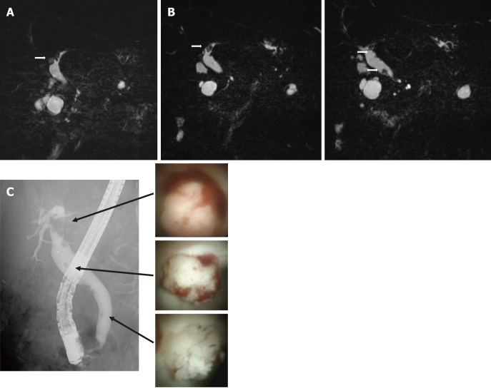 Follow-up imaging after diagnosis. A: Six months after magnetic resonance cholangiopancreatography (MRCP) showing a defect of the left intrahepatic duct. B: One year after MRCP showing a defect in the left intrahepatic duct and multiple defects in the extrahepatic duct. C: Endoscopic retrograde cholangiography showing multiple filling defects of contrast agent in the extrahepatic and intrahepatic ducts. Peroral cholangioscopy showing papillary tumors in the intrahepatic and extrahepatic ducts.