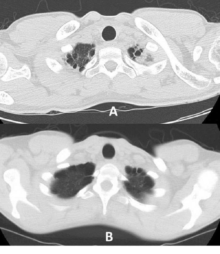 CT scan showing high-grade DSS: A) grade 5 DSS (multiple bilateral blebs), and B) grade 6 DSS (multiple bilateral bullae).