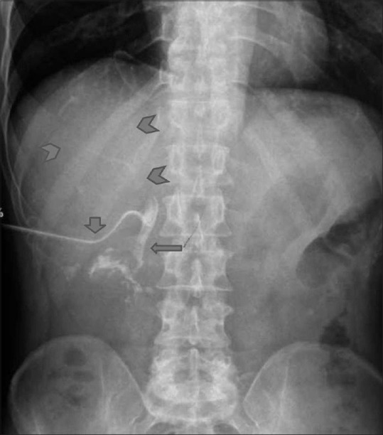 T-tube cholangiogram reveals lack of contrast opacification of the common hepatic duct and intrahepatic biliary radicles (arrowheads). Note the opacified CBD (arrow) and T-tube in situ (short arrow)