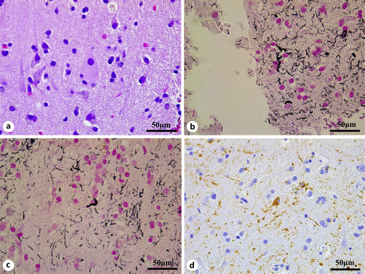 Pathological findings. HE staining: a ballooned neuron in the right parietal cortex (a). Gallyas-Braak staining: innumerable neuropil threads (b) and a coiled body (c) are seen. There are no astrocytic plaques. AT8 immunostaining: positivity of the neuropil threads and the cytoplasm of a neuron (d). AT8, a monoclonal antibody against phosphorylated tau; HE, hematoxylin-eosin.