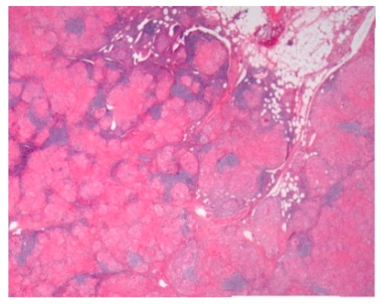 Mediastinal nodal sarcoidosis. H&E Magnification 20×.