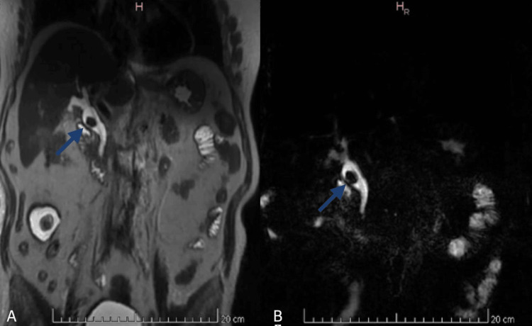 Magnetic resonance cholangiopancreatography (MRCP).Coronal MRCP image showing the absence of the gallbladder and cystic duct. A single 20 mm filling defect is observed within the common bile duct (blue arrow), consistent with a gallstone.