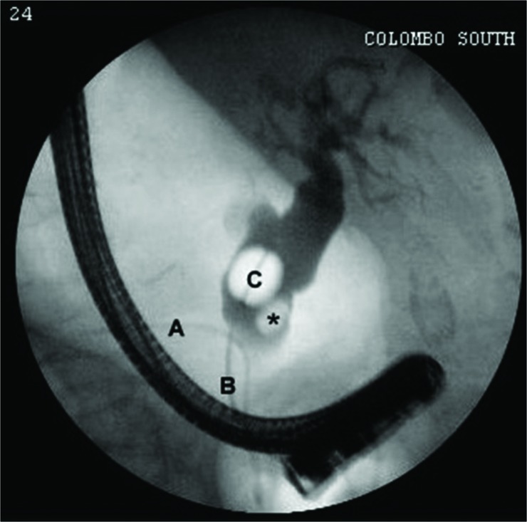 Cholangiogram of a 62-year-old male patient presented with a distal common bile duct (CBD) stone (*) causing CBD dilatation and intrahepatic duct dilatation. Prophylactically inserted pancreatic duct stent (A) after accidental cannulation of the pancreatic duct, balloon catheter (B) with the inflated bulb (C) are also seen.
