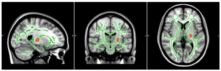 Significant FA cluster (CON > NTP, p < 0.05, corrected). Significant findings of the left internal capsule are displayed. Significant clusters bolded using FSL’s TBSS fill command. Axial and coronal view are in radiological view (left = right). P = Posterior; A = Anterior; R = Right; L = Left.