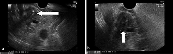 a, b EUS images showing the distal CBD mass.