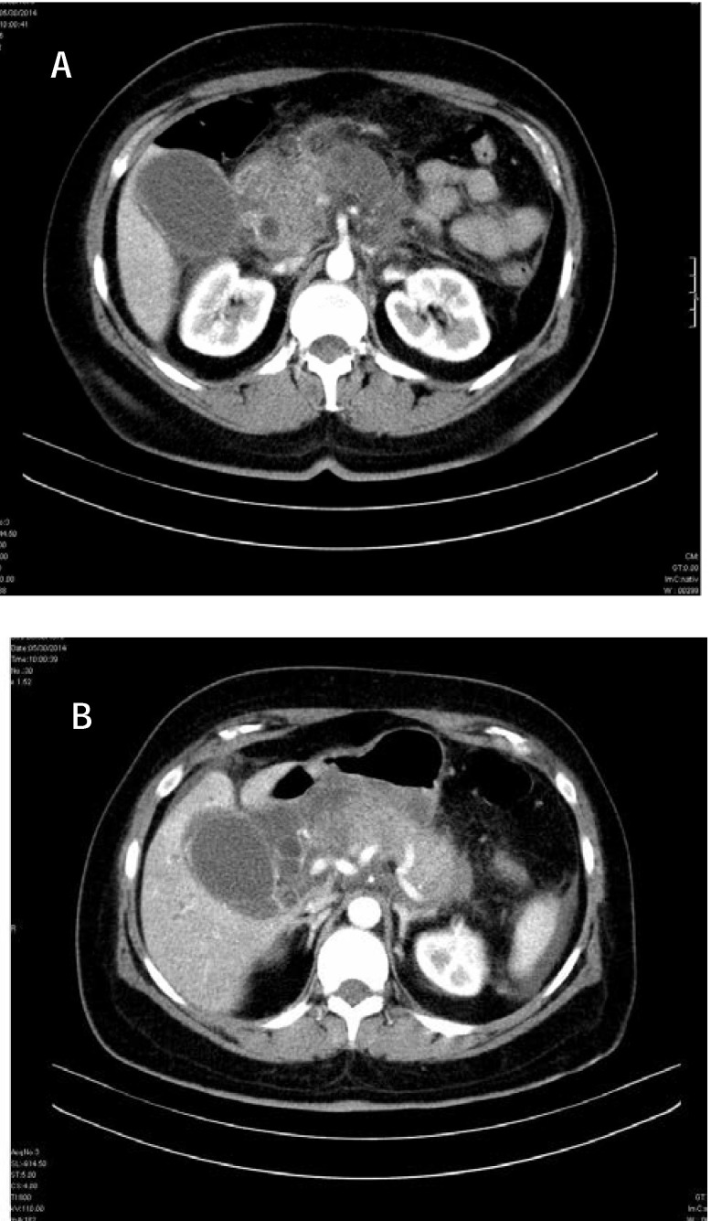 CECT Small papillary calculus, CBD dilatation, acute pancreatitis