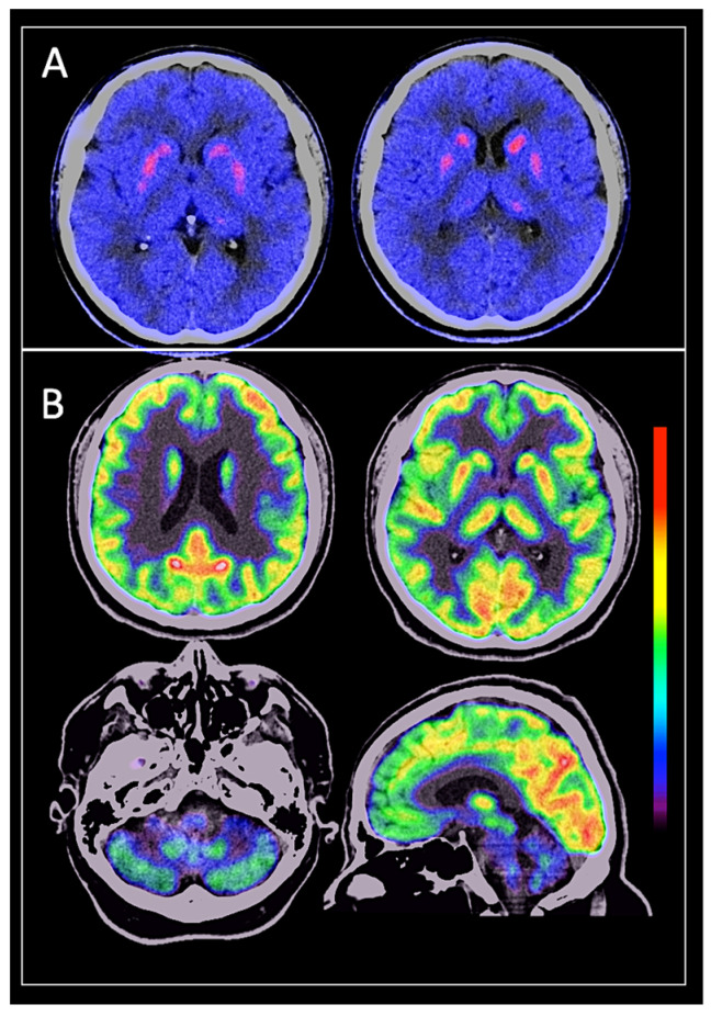 50-year-old male with PD and myoclonus diagnosed 3 years ago. He was assessed by the movement disorders specialist, who established clinically the diagnosis of PD. Images show brain dual PET-CT study. (A) FDOPA PET reveals severely decreased uptake in caudate and putamen nuclei symmetrically. (B) FDG PET shows hypometabolism in the posterior third of both putamen nuclei and cerebellar hemispheres; metabolism in the rest of the encephalous is preserved. Imaging findings are consistent with MSA-C diagnosis.