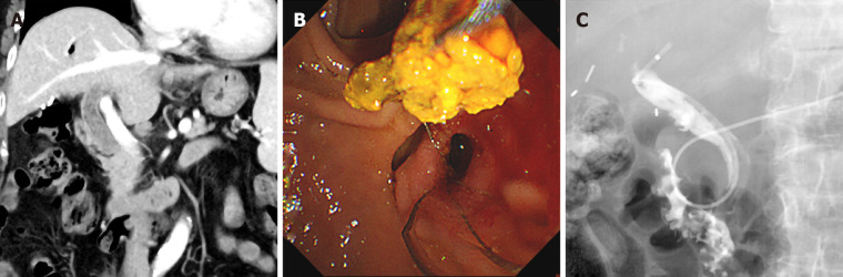 Computed tomography imaging and endoscopic retrograde cholangiopancreatography. A: Computed tomography revealed multiple stones in the common bile duct; B: Stones were removed by Endoscopic retrograde cholangiopancreatography using a Dormia basket; and C: Follow-up tubography using an endoscopic nasobiliary drainage showed no definite filling defects in the common bile duct.