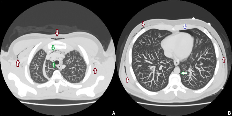 Axial CT of the thorax demonstrating extensive surgical emphysema (red arrows) in the chest wall, associated left-sided pneumothorax (blue arrow), and pneumomediastinum (green arrows) with air outlining the mediastinal structures.CT: computed tomography