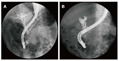 Failure of endoscopic stenting of common bile duct stricture demonstrated by endoscopic retrograde cholangiopancreatography findings in a male patient with a long stricture (36.0 mm). A: Before stent therapy; B: After 1 year of stent therapy.