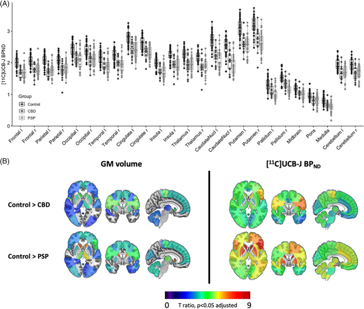 (A) Baseline regional [11C]UCB‐J BPND in healthy volunteers (n = 31) and patients (progressive supranuclear palsy [PSP], n = 32; corticobasal degeneration [CBD], n = 16) in major regions of interest. (B) t‐Statistic maps comparing regional gray matter (GM) volume and [11C]UCB‐J BPND (CSF corrected) in patients versus controls. Only t values, significant at P < 0.05 adjusted for multiple comparisons, are shown; higher t values illustrate greater volume and synaptic loss; orange/red = more severe atrophy/loss). [Color figure can be viewed at wileyonlinelibrary.com]