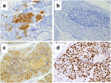 Immunohistochemical findings in the component of adenocarcinoma. There were no immunopositive cells in the adenocarcinoma component. a Immunostaining for synaptophysin was negative. b Immunostaining for chromogranin A was negative. c Immunostaining for CD56 was negative. d Immunostaining for Ki-67 showed diffused positivity in 27% of the adenocarcinoma cells