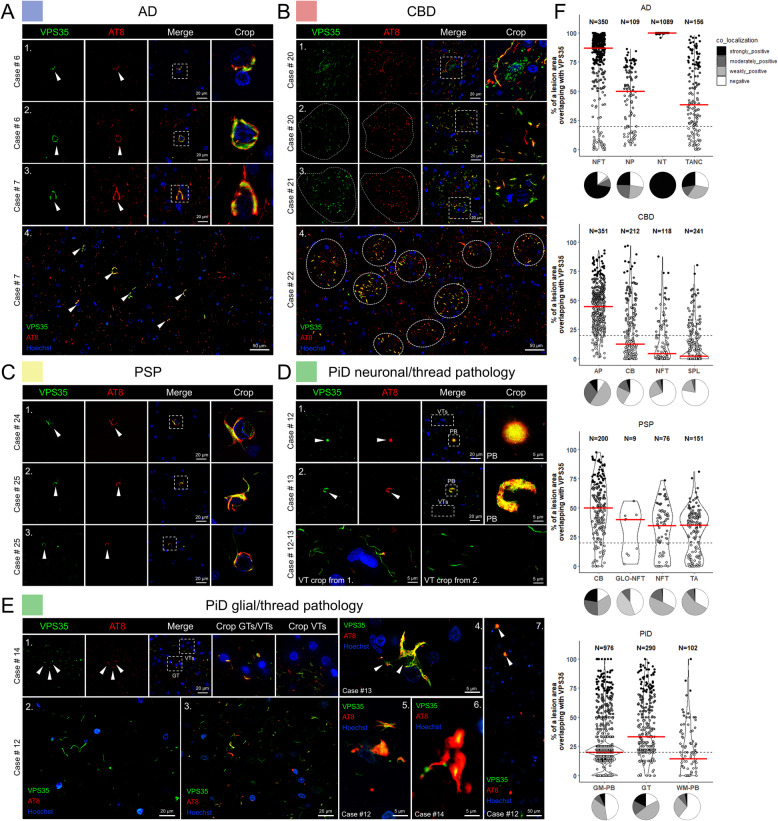 VPS35 co-localizes with specific disease-related AT8-positive tau lesions in post-mortem frontal cortices from major tauopathies. A Co-immunostaining of AD brain sections revealed a robust colocalization between VPS35 and phospho-tau (white arrowheads) in neuronal tau lesions, including pre-tangles (series 1), neurofibrillary tangles (NFTs) (series 2), and more mature NFTs (series 3). Co-localization between VPS35 and AT8 phospho-tau is common in NFT-burdened brain regions (series 4). B VPS35 is sequestered in APs in CBD brains (series 1–4). Individual APs in 4 are denoted by dashed circles. C VPS35 is sequestered in CBs in PSP brains (series 1–3, white arrowheads indicate co-localization). D Circumscribed neuronal PBs displayed VPS35 punctate staining within the cores of the tau inclusions (series 1), whereas in larger ‘horseshoe’ shaped neuronal PBs VPS35 puncta were more evenly distributed (series 2, white arrowheads indicate co-localization). In addition, in PiD we observed frequent occurrence of VPS35 thread structures (VTs) that colocalized with AT8 but were mostly AT8-negative (series 1–2, VTs insert). E VPS35 is sequestered in glial phospho-tau inclusions (GTs), including oligodendroglial (series 1, Crop GTs/VTs insert) and astrocytic [4–6] phospho-tau inclusions in PiD. Small clusters of VTs were sometimes observed in the vicinity of AT8 oligodendroglial inclusions (series 1, Crop GTs/VTs and Crop VTs inserts). Larger clusters of VTs varied in lengths (series 2). In dense areas of VTs some portion of them was AT8 positive (series 3). Grey matter Pick body inclusions were positive for VPS35 (series 7, white arrowheads), yet at the border of the white matter, smaller spherical inclusions were negative for VPS35. F Quantification of VPS35-positive phospho-tau lesions from n = 3 cases/tauopathy showing the relative area of overlap between AT8 and VPS35 in tauopathy lesions. Modified violin plots with data points show individual lesions plotted against relative overlap area. Lesions are categorized into co-localization categories based on their relative area of overlap. Red lines indicate median values. Pie charts underneath the violin plots illustrate the relative proportions of lesions with different degrees of co-localization. Abbreviations: VPS35, vacuolar protein sorting-associated protein 35; AD, Alzheimer’s disease; PiD, Pick’s disease; CBD, corticobasal degeneration; PSP, progressive supranuclear palsy; PTs, pre-tangles; NFTs, neurofibrillary tangles; TANCs, tangle-associated neuritic clusters; APs, astrocytic plaques; CBs, coiled bodies; PBs, Pick bodies; VTs, VPS35 threads; GT, glial tau; NTs, neuropil threads; NP, neuritic plaques; SPL, small phospho-tau lesions; TA, tufted astrocytes; GLO-NFT, globose NFTs; GM PB, grey matter Pick Body; WM PB, white matter PB
