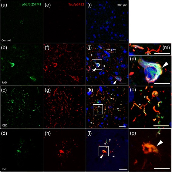 The autophagic marker p62/SQSTM1 accumulates and colocalizes with hyperphosphorylated tau in human tauopathies. Double immunohistochemistry against p62/SQSTM1 (green), hyperphosphorylated tau (Tau/pS422, red) and DAPI (blue) are shown by confocal analysis. a In control individuals, p62/SQSTM1-positive inclusions are only rarely observed and (e, i) no Tau/pS422 immunoreactivity were detected. b-h Strong immunoreactivity of p62/SQSTM1 (b-d) and Tau/pS422 (f-h) in post-mortem brain sections from FAD, CBD and PSP patients. j-l Merged pictures show colocalization between p62/SQSTM1 and Tau/pS422. j In FAD patients, colocalization is shown in neuronal threads (asterisks and high magnification m) and close to the nucleus (arrowheads and high magnification n). k, o In CBD patients, asterisks indicate colocalization in threads. l, p In PSP brains, colocalization is detected in threads (asterisks) and in some cell bodies (arrowheads). Scale: 20 μm (10 μm insert)