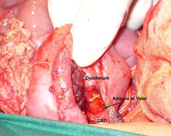 Figure 2: Operative view showing partial CBD avulsion.