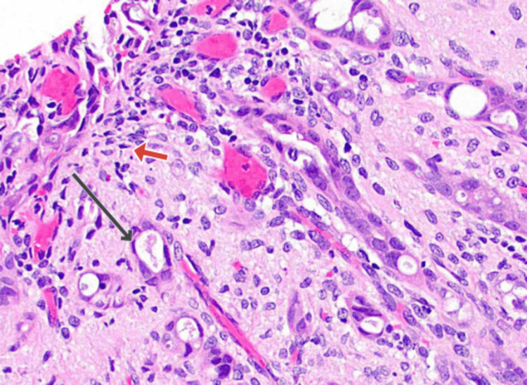 Histopathology of biopsy taken from distal CBD via ERCP brush cytology showing pleomorphic cells with inflammatory cells forming glandsThe black arrow indicates the glandular structure formed by adenocarcinoma cells. The red arrow shows the pleomorphic cell.CBD, common bile duct; ERCP, endoscopic retrograde cholangiopancreatography