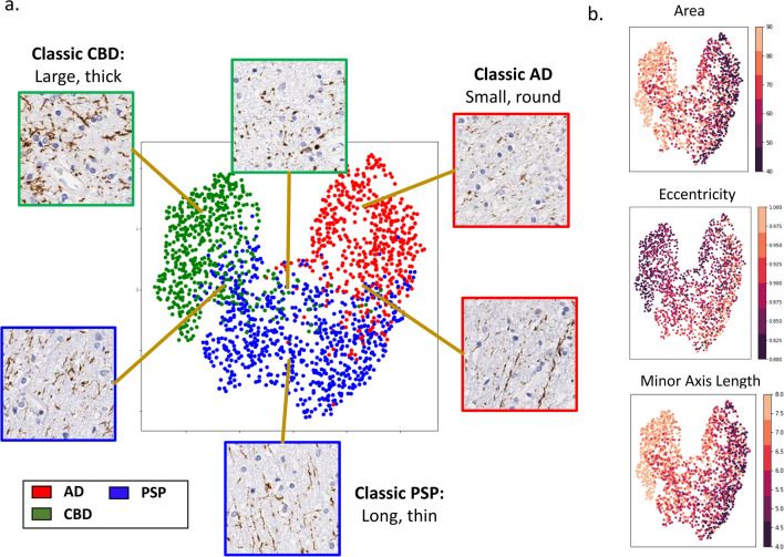 Interpretation of WM pathological features used for disease classification. a UMAP visualization of image patches clustered based on their similarity as perceived by the automated disease classifier (based on the 1024-dimensional output of the penultimate layer of the model; “Methods”). Data points are colored based on their ground truth disease label and representative images of data at different areas within clusters are displayed. b The same UMAP visualization from a with data points instead colored by the average feature values (across aggregates in the corresponding image patch) for area, eccentricity, and minor axis length