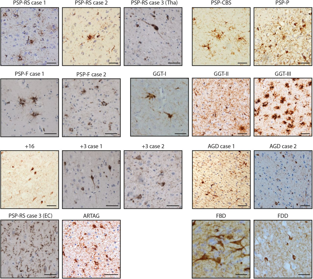 Tau immunohistochemistryTau staining of the brain regions used for cryo-EM structure determination (see Methods), using antibody AT8 (pS202/pT205 tau). Scale bars are 50 μm, except for GGT Type I, FBD and FDD, where they are 25 μm. For PSP-RS case 3, both the thalamus (Tha) and the entorhinal cortex (EC) are shown.