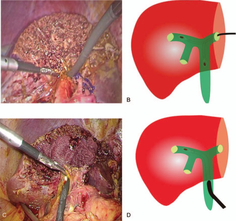 Choledochoscope through the left hepatic duct (LHD) stump or the common bile duct (CBD) incision to explore the biliary tract. (A) Choledochoscope through the LHD stump to explore the biliary tract; (B) Schematic diagram of bile duct exploration and stone removal through the LHD stump; (C) Choledochoscope through the CBD incision to explore the biliary tract; (D) Schematic diagram of bile duct exploration and stone removal through the CBD incision. CBD = common bile duct, LHD = left hepatic duct.