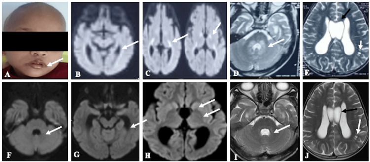 Clinical and magnetic resonance imaging (MRI) image of the patient with biotinidase deficiencyClinical photograph (A) of the patient showed alopecia with cheilitis (white arrow). The MRI image (axial DWI image) (B,C) showed relatively symmetrical restricted diffusion in the bilateral peritrigonal white matter (white arrow in B), bilateral genu, and posterior limbs of internal capsules (white arrows in C). The axial T2 image at the level of the pons (D) showed T2 hyperintensity surrounding the fourth ventricle in the pons, both middle cerebellar peduncles, and the dentate nuclei (white arrow). The axial T2 image at the level of the lateral ventricle (E) showed the cavum septum pellucidum (black arrow) and dilated Virchow-Robbins space (VRS) (white arrow). Follow-up MRI axial diffusion (F-H) and axial T2 (I,J) after two weeks of biotin supplement showed complete resolution of restricted diffusion (white arrows in F-H) and T2 hyperintensities (white arrow in I) in the corresponding regions with persistent cavum septum pellucidum (black arrow in J) and dilated VRS (white arrow in J).