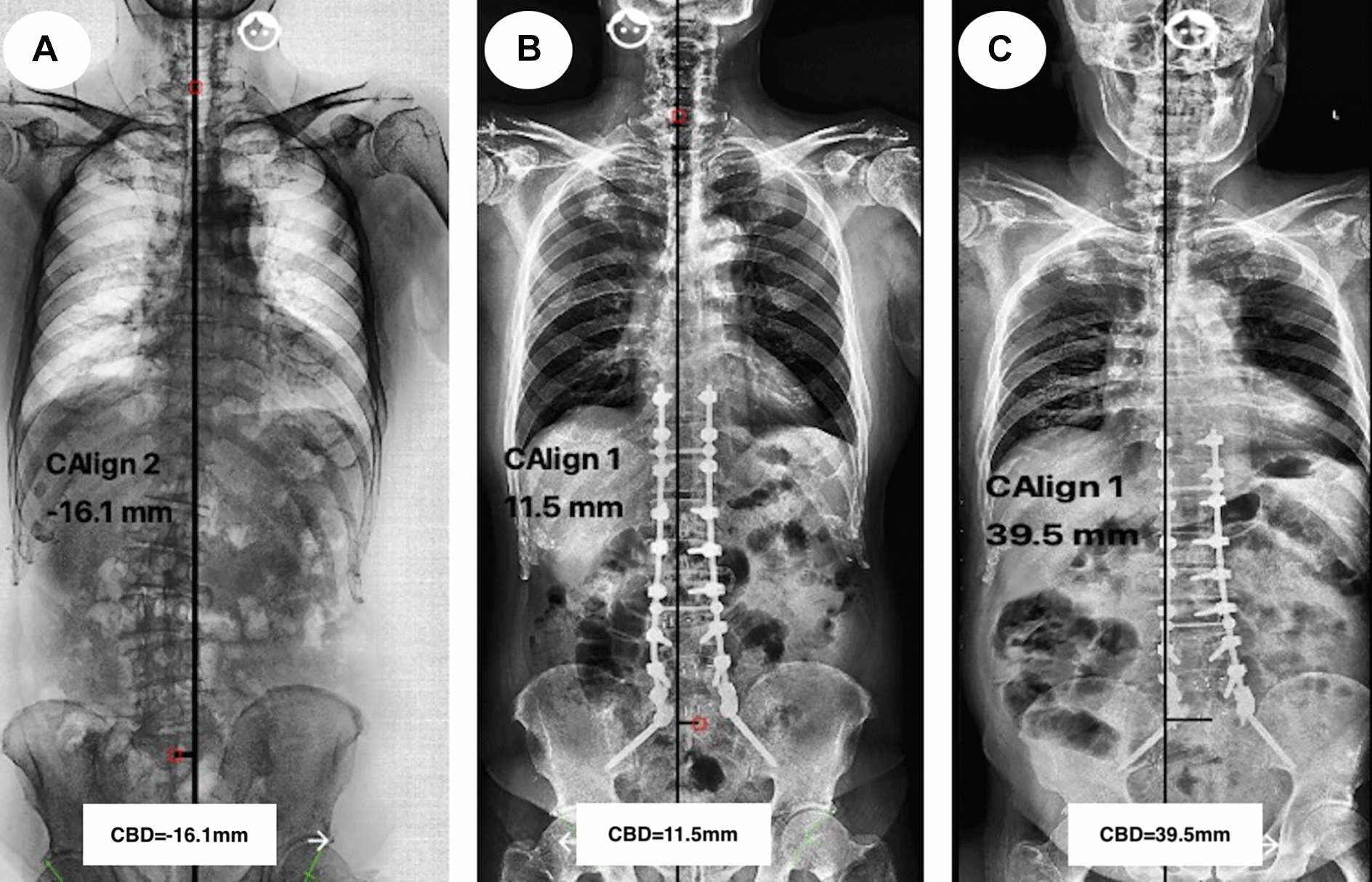 A 68-year-old male ASD patient underwent long-fusion correction surgery (T10–S2), the CBD was − 16.1 mm at pre-operation (A), changed to 15.5 mm at the immediate post-operation (B), and increased to 39.5 mm at the final follow-up (C)