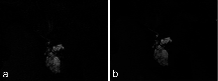 Magnetic resonance cholangiopancreatography of a male patient in his 80 s demonstrating a multilocular pancreatic cystic lesion (PCL). (a) Original image. (b) Image reconstructed using super-resolution deep learning reconstruction (SR-DLR). Internal septations of the PCL are more clearly delineated in the SR-DLR image. Three readers rated the depiction of the PCL as 4/2/4 for the original images and 4/4/4 for the SR-DLR images. Higher scores indicate better depiction