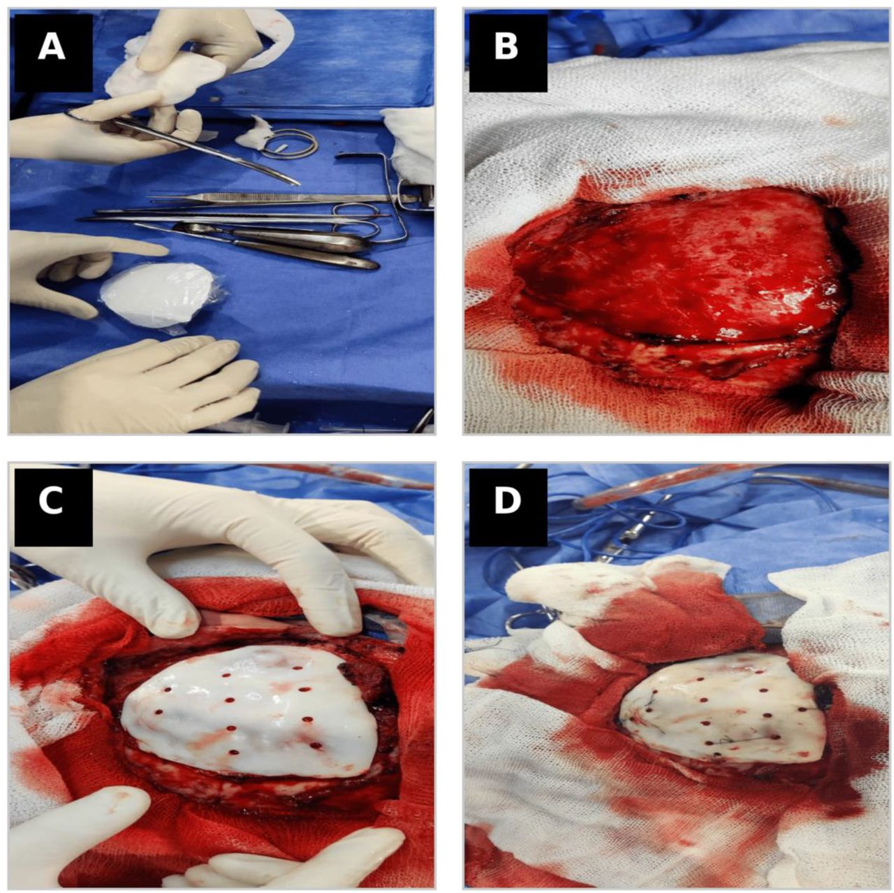 Intraoperative fabrication and placement of patient-specific PMMA implant(A) Intraoperative preparation and handling of the PMMA implant(B) Intraoperative view of the cranial bone defect after exposure.(C) Implant positioned within the cranial defect.(D) Final fixation of the implant.