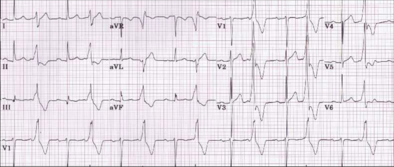 Electrocardiogram demonstrating ventricular bigeminy