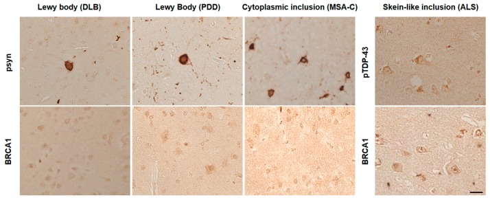Immunohistochemical studies using anti-BRCA1 antibodies in disease controls. BRCA1 positivity resembling phosphorylated α-synuclein (psyn) or phosphorylated TDP-43 (pTDP-43) positive inclusions was not observed in dementia with Lewy bodies (DLB), Parkinson’s disease with dementia (PDD), multiple system atrophy cerebellar type (MSA-C), or amyotrophic lateral sclerosis (ALS). The scale bar represents 20 μm.