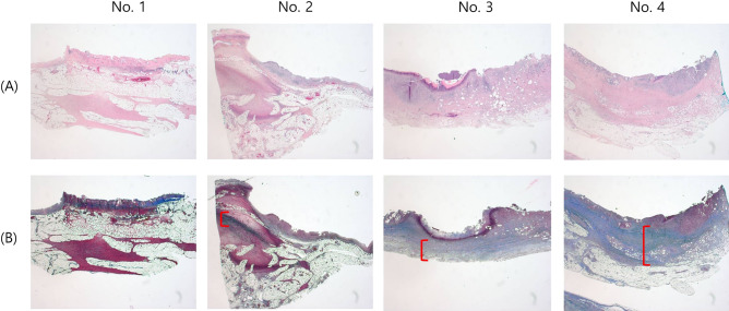 Histopathologic microscopic images of the APC application area of the CBD. Extensive abscesses replace the thickened wall at the APC application area of the first and second animals. Fibrosis is observed to begin in the second animal. In the third and fourth animals, abscess formation was greatly decreased, and the thickened wall is nearly replaced by fibrosis (parentheses indicate fibrosis thickness). (A). H&E; original magnification 40 × . (B) MT; original magnification 40 × .