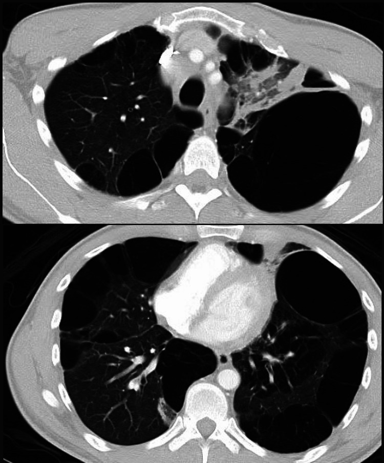 Computed tomography of the chest showing extensive bullous changes in the lungs bilaterally most prevalent in the left lower lobe. Extensive pleural-based consolidation in the left upper lobe extending from the hilum representing possible obstructive changes.