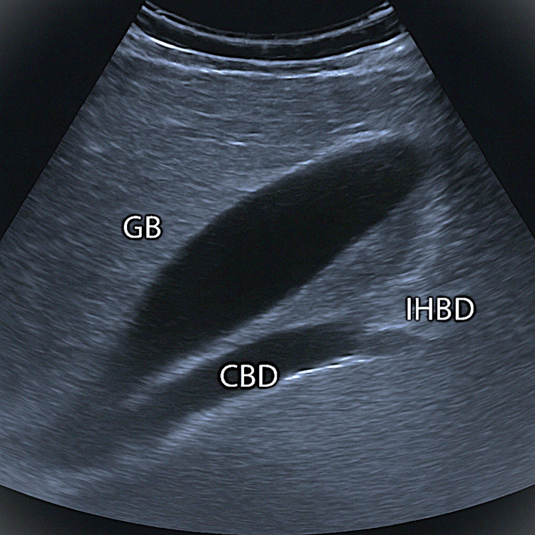 Ultrasound abdomen showing distended gallbladder and intrahepatic biliary dilatationGB: gallbladder; CBD: common bile duct; IHBD: intrahepatic biliary dilatation
