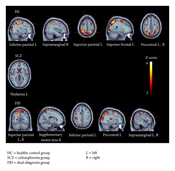 ROI brain activity when processing the mental rotation task in the 3 groups. HC: healthy control group; SCZ = schizophrenia group; DD = dual-diagnosis group; L = left; R = right.