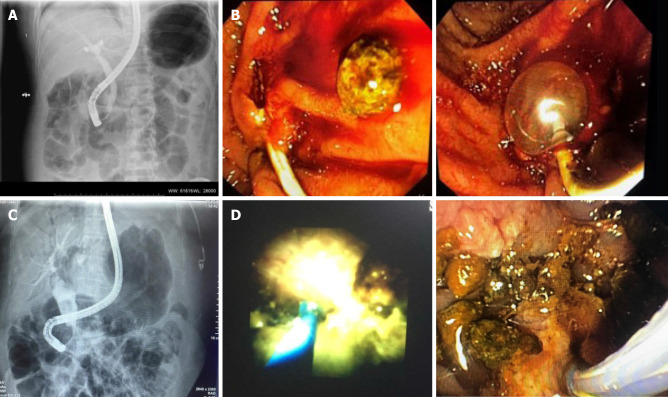 Multiple procedures or additional interventional techniques are often necessary to achieve complete stone clearance. A: A cholangiography image showing dilated biliary tract with distal narrowing and impacted stone. Endoscopy unit database Medistra Hospital, Jakarta; B: Endoscopy images of impacted distal common bile duct (CBD) stone removal with balloon. Endoscopy unit database, Medistra Hospital, Jakarta; C: The cholangiography image of a patient with CBD dilatation on the proximal and large CBD stone with distal narrowing. Endoscopy unit database, Medistra Hospital, Jakarta; D: Patient underwent laser lithotripsy with Spy Glass Cholangioscopy and multiple fragmentation of stones removal. Endoscopy unit database, Medistra Hospital, Jakarta.