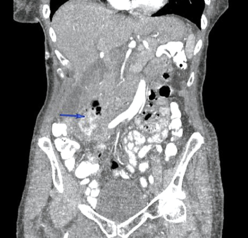 CT abdomen (coronal section) demonstrates a complex collection with a contained contrast leak related to the perforated duodenal diverticulum