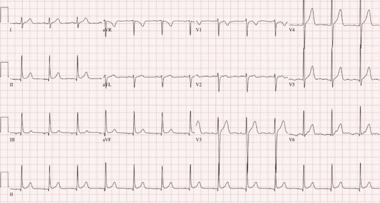 EKG on admission showing no signs of ischemia or arrhythmias