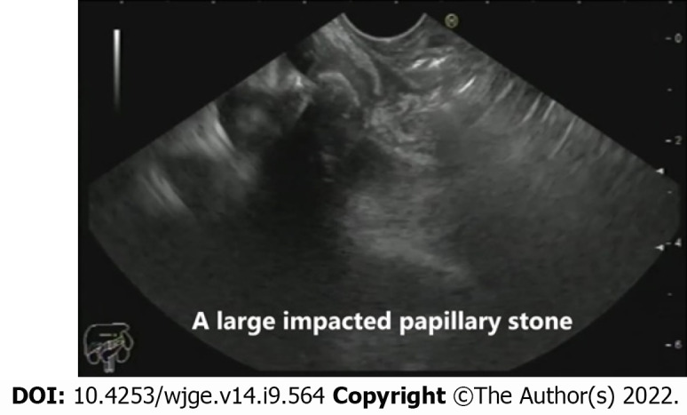 An impacted stone in the region of the major papilla as seen in the mid-second part of the duodenum.