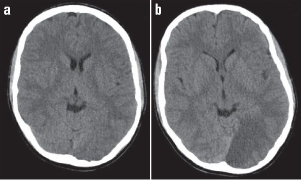 (a, b) Initial and control cranial MDCT