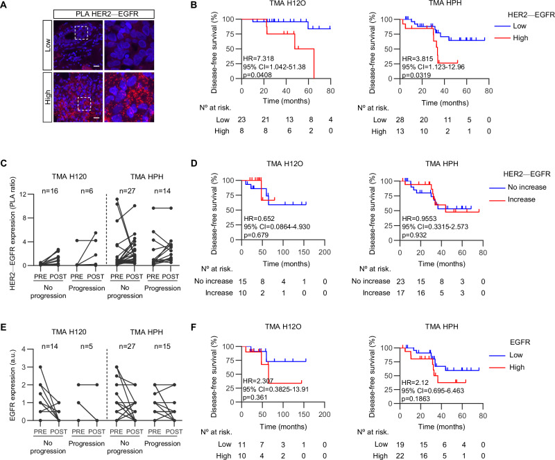 High post-NAT HER2-EGFR heterodimer burden predicts poor treatment outcomes.A Representative Proximity Ligation Assay (PLA) images of human samples exhibiting high and low HER2-EGFR heteromer expression. Red: PLA signal; blue: nuclear staining (DAPI). Scale bar, 50 μm. B Kaplan-Meier plots of disease-free survival for samples obtained after NAT and included in the tissue microarrays from Hospitals 12 de Octubre (TMA H12O) and Puerta de Hierro (TMA HPH). C Relative HER2-EGFR expression, as determined by PLA, in matched TMA samples. The left data columns in each panel represent samples from patients with no long-term disease progression, while the right columns represent the non-responders. Lines connect paired samples from the same patient before (PRE) and after (POST) NAT. D Kaplan-Meier plots of disease-free survival, stratified by type of change in HER2-EGFR dimer expression after NAT, in samples from the indicated TMAs. E Relative EGFR expression, as determined by PLA, in matched TMA samples before (PRE) and after NAT (POST). Data are represented as in (C). F Kaplan-Meier plots of disease-free survival, stratified by type of change in EGFR expression after NAT.