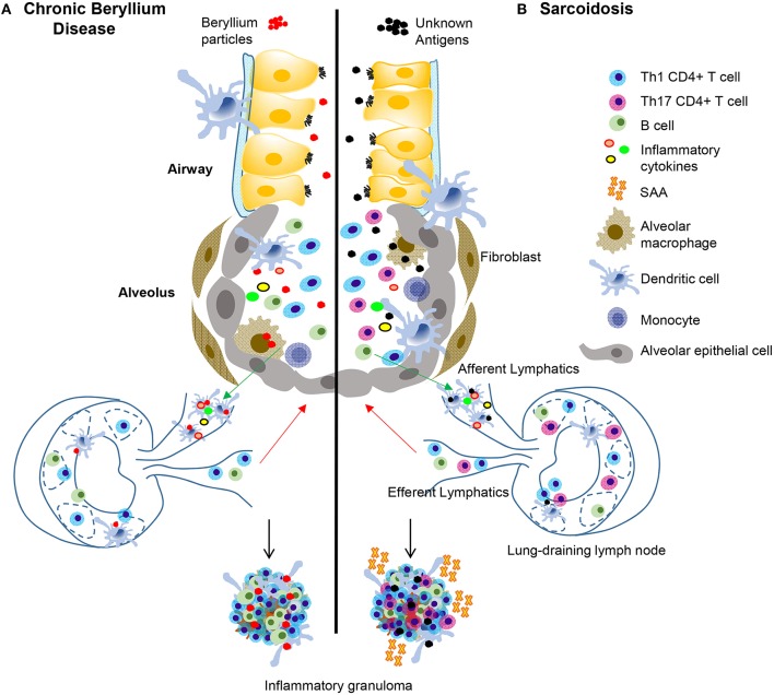 Immunopathogenesis of chronic beryllium disease and sarcoidosis. In CBD (A), beryllium particles enter the lung and generate an immune response. In sarcoidosis (B) unknown antigens induce an immune response after entering the lung. In CBD, beryllium particles cause the release of DAMPs in the airways, which promote activation and migration of DCs. Either beryllium (A) or unknown antigens (B) are taken up by alveolar macrophages and dendritic cells in the lung and are transported to lung-draining lymph nodes. In the lymph nodes, antigen specific CD4+ T cells are stimulated by activated antigen-presenting cells expressing certain HLA molecules dependent on disease (see Table 1). T-B cell interactions also occur in the lymph nodes and commitment of B cells to antibody production takes place in the germinal centers. Antibodies and activated B and T cells circulate back to the lung to generate an adaptive immune response against the target antigen. In CBD, Th1 CD4+ T cells that display an effector memory phenotype are the primary cell type, but there is also an infiltration of activated B cells in the lungs that help form granulomatous structures (A). In sarcoidosis and CBD, Th1 CD4+ T cells make up the majority of the cell population in the lungs. In sarcoidosis, but not CBD, there are also Th17 and Th17.1 cells present. SAAs are also present in pulmonary granulomas of sarcoidosis patients, but not CBD, where they contribute to the inflammatory milieu and induce proliferation of pathogenic, inflammatory Th17 cells. In both diseases, there is an abundance of Th1 inflammatory cytokines secreted by T cells and innate cells that propagate the inflammatory environment, including TNF-α, IFN-γ, IL-1, and IL-2.