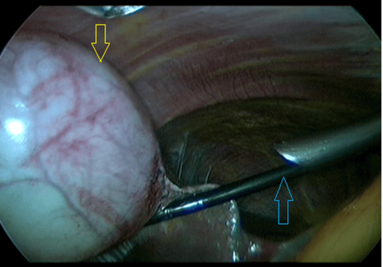 Laparoscopic View Following ERCPIntraoperative laparoscopic image demonstrating a distended gallbladder (yellow arrow) during cholecystectomy performed after endoscopic retrograde cholangiopancreatography (ERCP). A laparoscopic grasper (blue arrow) provides cephalad traction on the gallbladder fundus, to facilitate exposure of the cystic structures. This image illustrates the impact of bowel distension following ERCP on laparoscopic visualization.