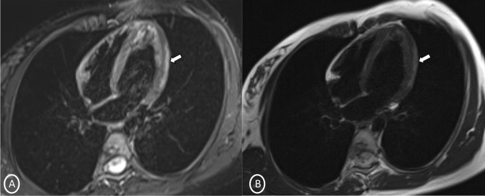 Long-axis 4 chambers A T2 STIR Dark blood; B T2 Dark blood—showing patchy T2 hyperintensity in subepicardial region along left lateral wall