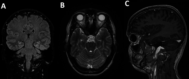 Post-onset MRI at 33 days: The imaging study, comprising coronal, axial, and sagittal views from left to right, compared to a 10-day post-onset MRI. The latest scans show a notable reduction in signal abnormalities in the globus pallidum. However, persistent signal alterations remain in the cerebellum and both hippocampi, as seen on FLAIR sequences, although these have lessened since the previous imaging. Ventricular size is standard, and the basal cisterns are intact