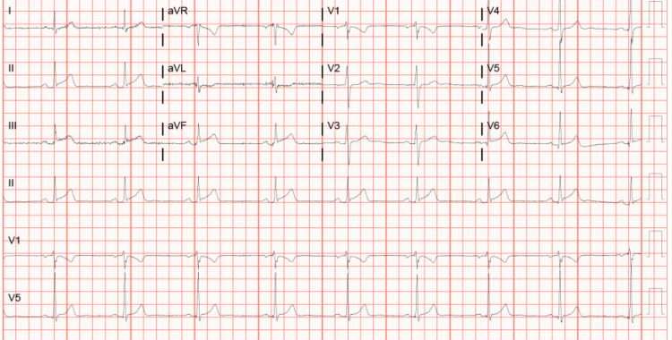 Serial EKG showing progressive changes in leads II, III, and aVFEKG: electrocardiogram