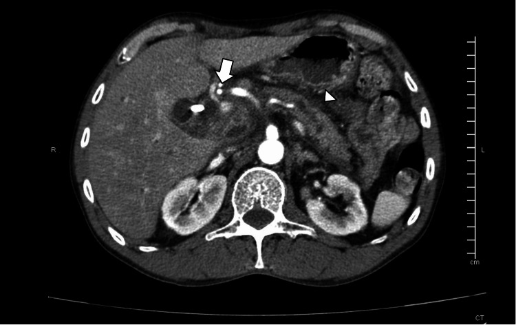 Axial contrast-enhanced CT scan showing a biliary stent (arrowhead) within the common bile duct and peripancreatic fat stranding with edema (arrow), consistent with acute pancreatitisCT: computed tomography