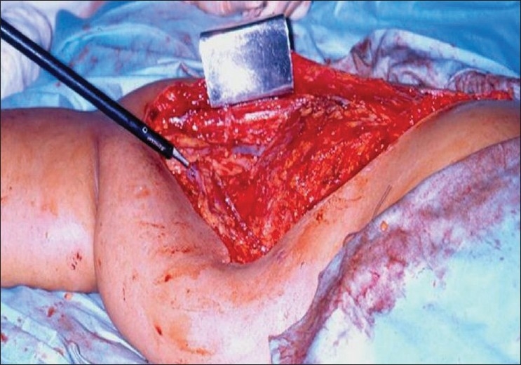 Modified radical mastectomy: Intraoperative photograph
