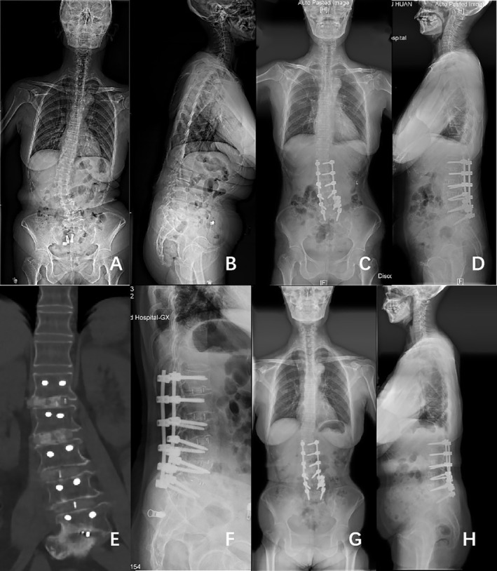 Case example of a 62‐year‐old female with DLS who underwent surgical correction consisting of L1–L5 OLIF with posterior instrumentation. (A and B) Full‐length standing posteroanterior and lateral radiographs before operation (Cobb 32.0°, CBD 19.84 mm, PI 58.3°, PT 36.3°, SS 22.1°, TK 2.9°, LL 1.5°, SVA 145.25 mm). (C and D) Posteroanterior and lateral standing radiographs 1 year after operation (Cobb 8.0°, CBD 13.51 mm, PI 58.3°, PT 35.8°, SS 22.8°, TK 15.5°, LL 26.8°, SVA 48.46 mm). (E) CT scan 1 year after surgery showed bone fusion at L1–L5. (F) Cage subsidence was observed 1 year after surgery. (G and H) Posteroanterior and lateral standing radiographs 2 years after operation (Cobb 8.6°, CBD 15.83 mm, PI 52.8°, PT 35.7°, SS 17.3°, TK 6.5°, LL 17.5°, SVA 51.84 mm).