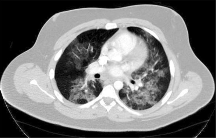 Axial CT Chest Scan with IV contrast: Diffuse bilateral ground-glass opacities throughout both lungs, demonstrating predominantly a perihilar distribution, with areas of mild bronchial wall thickening. Several mildly prominent hilar lymph nodes, the largest measuring 1.2 cm in the short axis on the right
