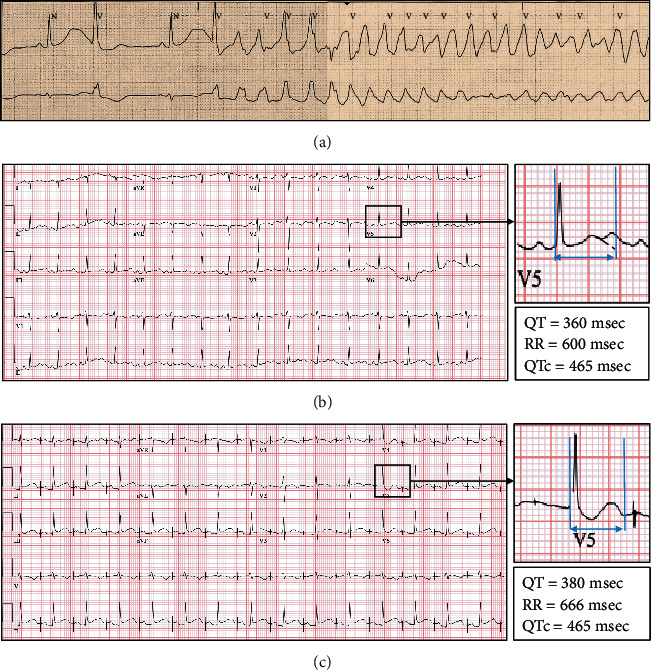 (a) Telemetry strip showing bradycardia with prolonged QTc and R-on-T premature ventricular contraction initiating Torsades de pointes; (b) ECG after starting isoproterenol drip with QTc reduction to 465 msec. (c) ECG showing atrial pacing after placement of dual-chamber ICD, with QTc of 465 msec, prior to starting nadolol.