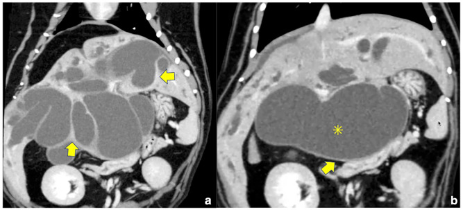 Coronal view of the abdominal CT scan. (a) Multiple dilated bile ducts are visible, including intrahepatic and extrahepatic ducts. Thickening and contrast enhancement of parts of the gallbladder wall and bile duct wall are observed (yellow arrows). (b) The duodenum is displaced to the left side by the dilated common bile duct (asterisk)